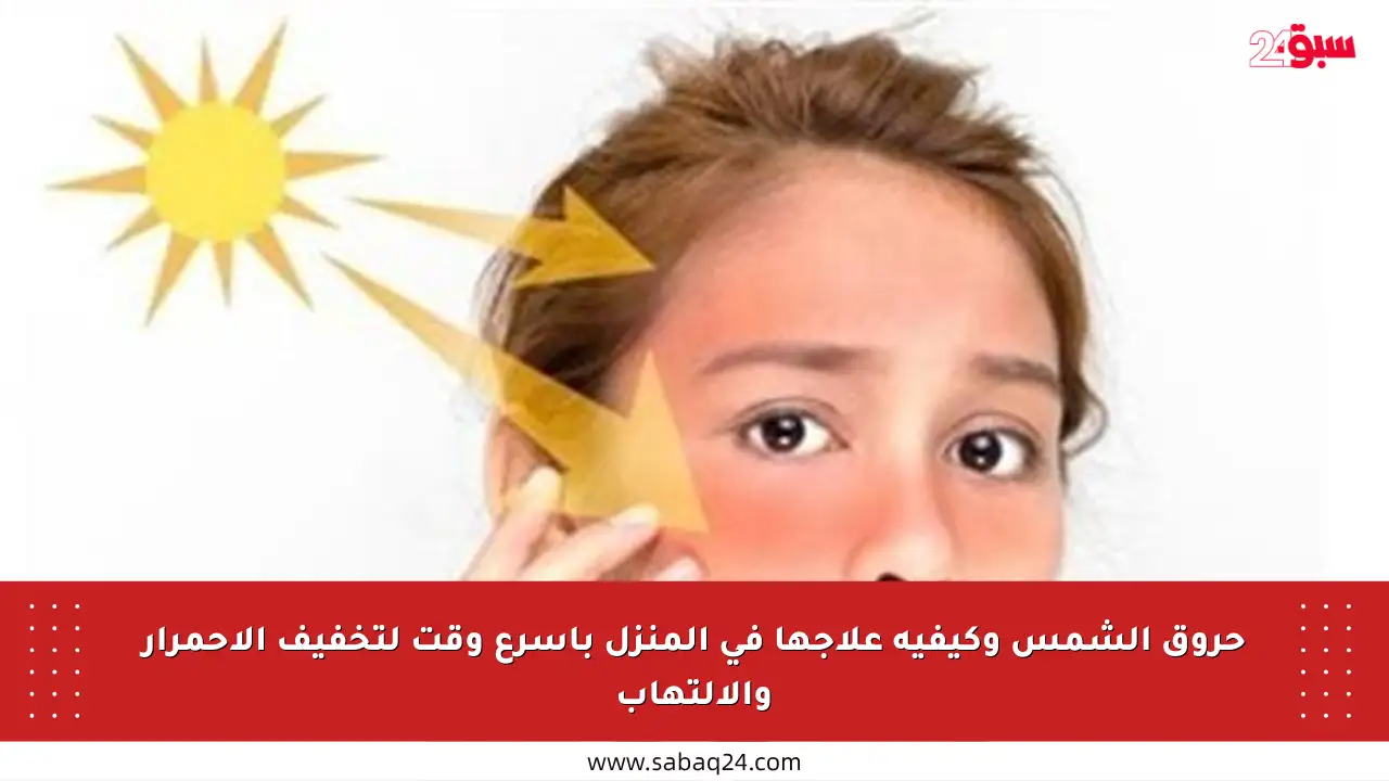 حروق الشمس وكيفية علاجها في المنزل بأسرع وقت لتخفيف الاحمرار والالتهاب